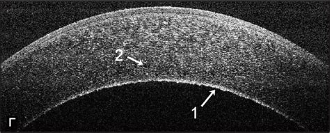 Fuch's Corneal Dystrophy Symptoms & Treatments Queens NY