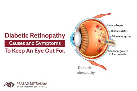 Diabetic Retinopathy: Causes and Symptoms