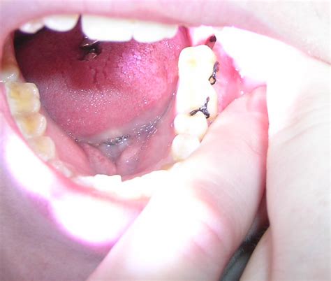 another close-up of my wisdom tooth dry socket (Alveolar o… | Flickr