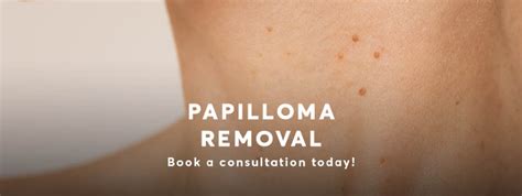 Papilloma Removal | Pulse Light Clinic London