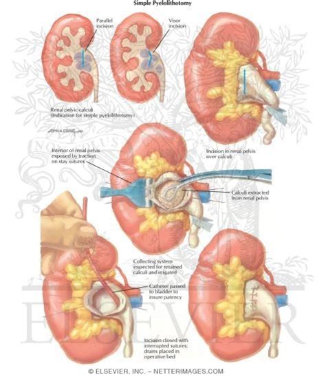 Urinary Calculi: Simple Pyelolithotomy