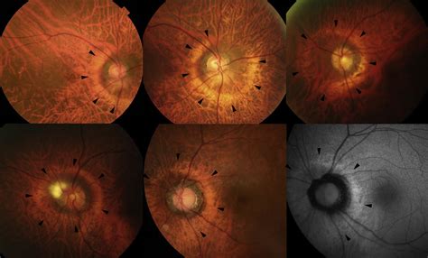 Characteristics of Peripapillary Staphylomas Associated With High Myopia Determined by Swept ...