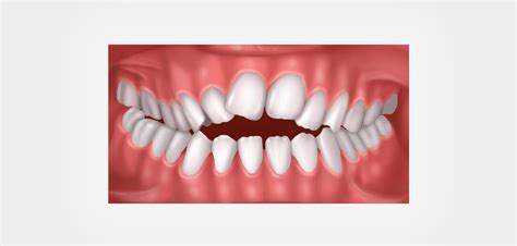 Anterior Open Bite - Mount Elizabeth Orthodontic Clinic