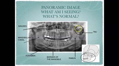 Radiographic Interpretation of Dental Anatomy - YouTube