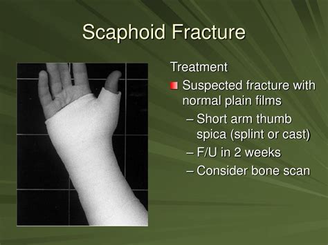 Scaphoid Fracture Thumb Spica Splint