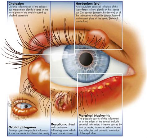 What’s The Difference Between A Meibomian Cyst And A Stye?