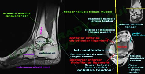 Foot Muscles Mri / Ankle And Foot Radiology Key - There are 10 ...