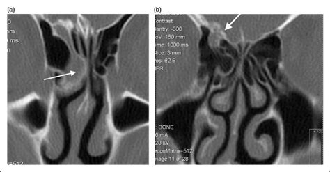 (a) CT Sinus scan: anomalous 'flask-shaped' anterior ethmoid air cell... | Download Scientific ...