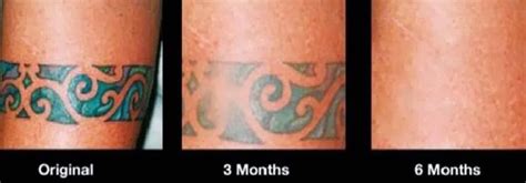 The Best Tattoo Removal Options and Alternatives Skin Color Tattoos, Green Tattoos, Red Ink ...