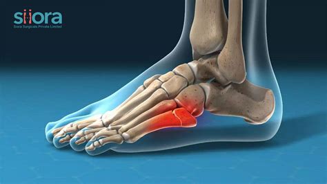 Avulsion Fracture — Causes, Symptoms, and Treatment - Siora Surgials ...