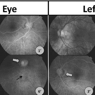 Fluorescein angiography of the right eye (left) and left eye (right)... | Download Scientific ...