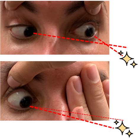 The OD's Practical Approach to Double Vision | Eyes On Eyecare