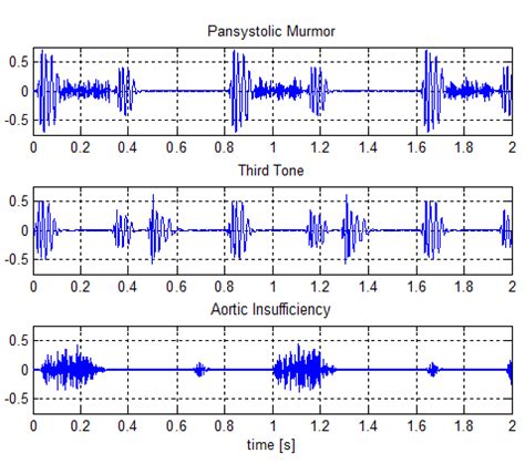 Three different types of heart pathologies: a) pansystolic murmur; b ...