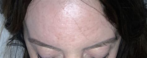 Forehead acne scars - Scar treatments - Acne.org