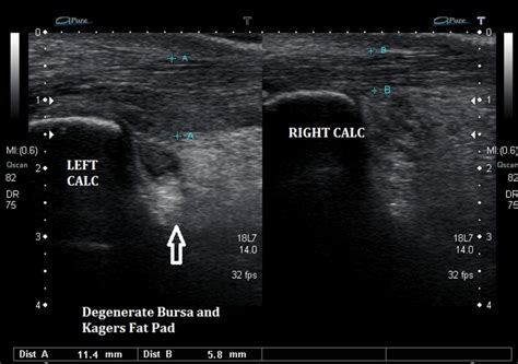 Kager's Fat Pad Inflammation - Ankle, Foot and Orthotic Centre