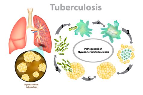 Lifestyle Changes to Treat Tuberculosis at Home - Apollo Hospitals Blog