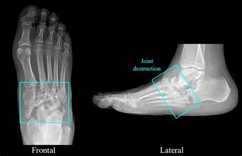 RadiologySpirit: Neuropathic Arthritis / Charcot Foot