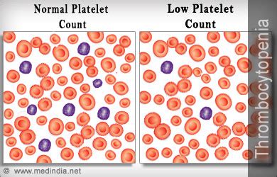 Thrombocytopenia / Low Platelet Count - Causes Symptoms Diagnosis Treatment