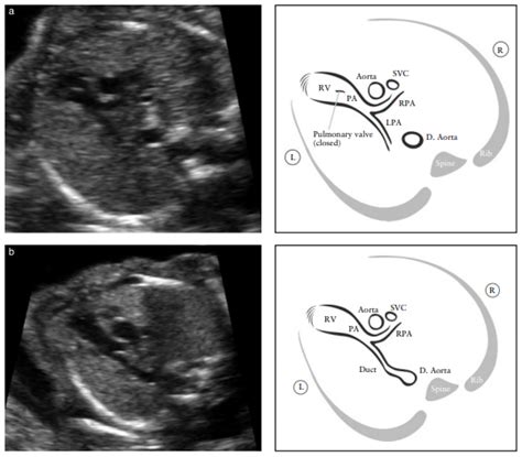 Right ventricular outflow tract (RVOT) view