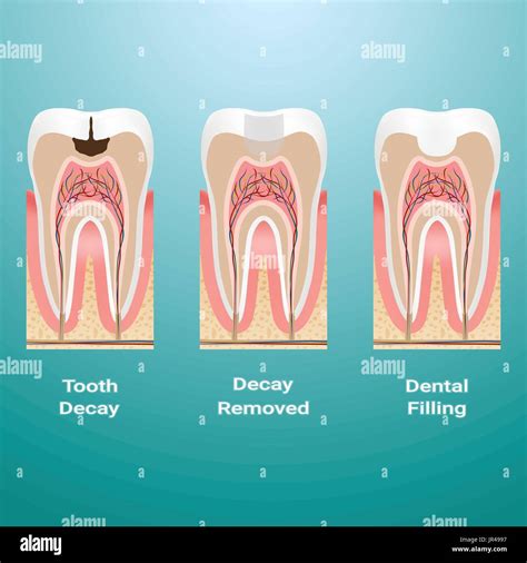 Treatment Of Caries. Dental Filling. Dental Caries Detailed Isolated On ...