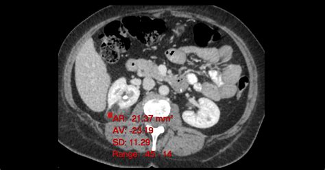 Renal Angiomyolipoma - Manal's Classroom