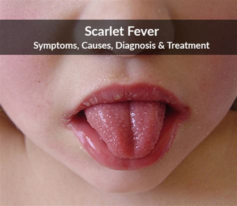 Fever Symptoms Lips | Lipstutorial.org