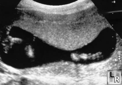 LearningRadiology - Placental Grading