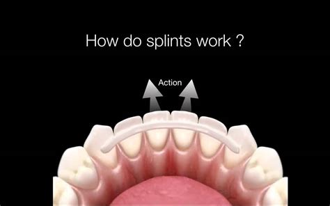 Will mewing work if I have dental splints on my front teeth? : orthotropics