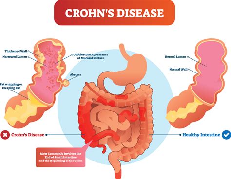 Crohn's Disease: What You Need To Know - Parkland Natural Health in London