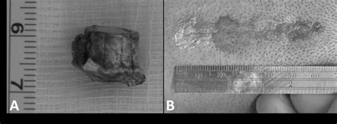 Cervical spinal cord bullet fragment removal using a minimally invasive surgical approach: a ...