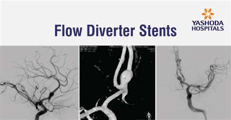 Flow Diverter Stents - Types, Treatment, Risks and Complications