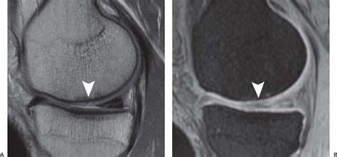 Articular Cartilage | Radiology Key