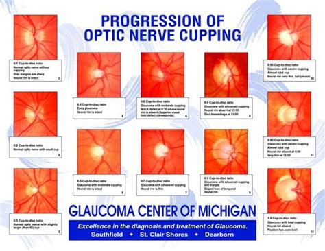 Progression of optic nerve cupping | Eye health, Eye facts, Optometry