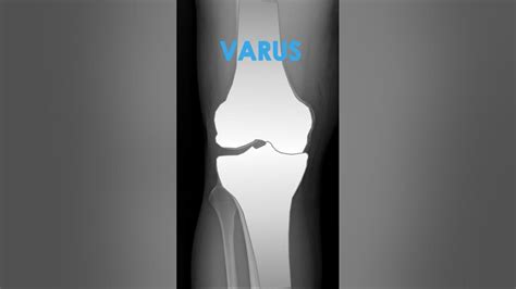 Varus - Valgus Deformities of the Knee on X-Ray #kneepain #radiology #anatomy - YouTube