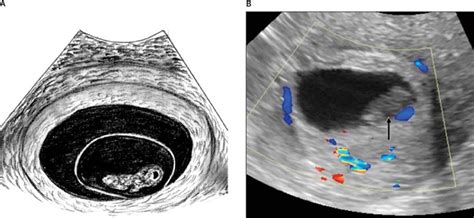 Sonographic Evaluation of the Yolk Sac - Tan - 2012 - Journal of Ultrasound in Medicine - Wiley ...