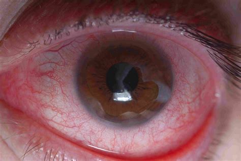 Learn more about the most effective form of cataract surgery