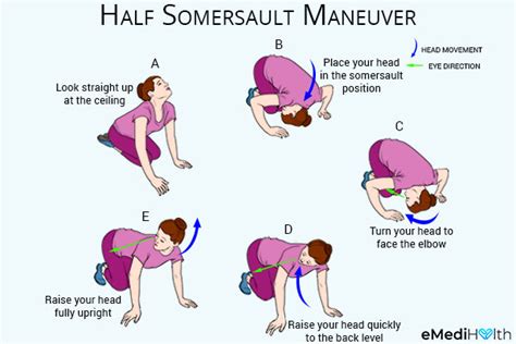 Get Epley Maneuver Vertigo Exercises Images