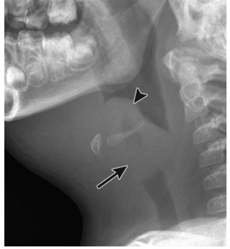 Swollen Epiglottis Treatment