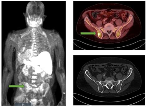 PET/CT For Prostate Cancer - Charter Radiology