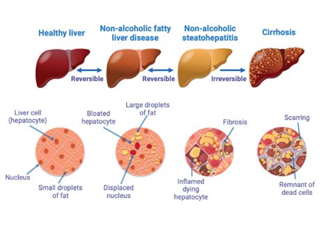 Uncovering the genetic causes of fatty liver disease — a growing health concern