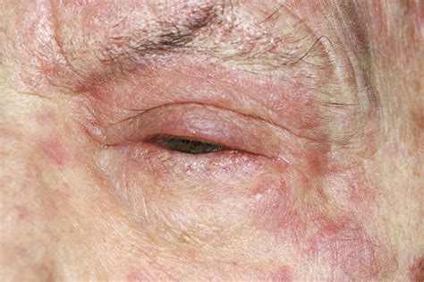 Shingles rash - Stock Image - M260/0324 - Science Photo Library