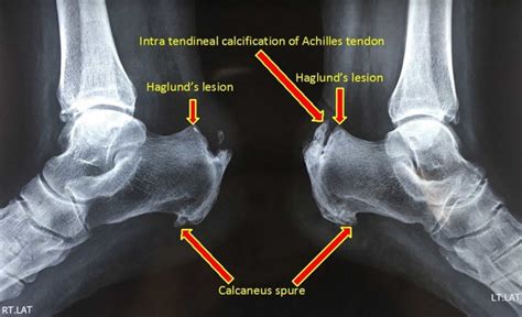 Exostosis causes, symptoms and exostosis treatment