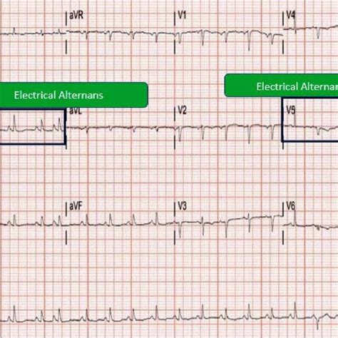 ECG Showing Electrical Alternans. | Download Scientific Diagram