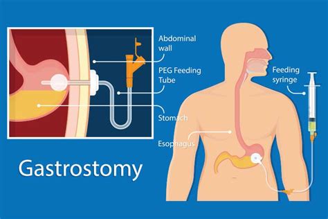 Enteral Feeding and Tube Management | Ausmed