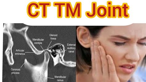 CT TM Joint Scan Easy Filming Technique in #Hindi #Seimens #Tmj # ...