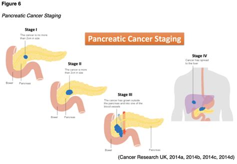 Pancreatic Cancer for APRNs Nursing CE Course | NursingCE