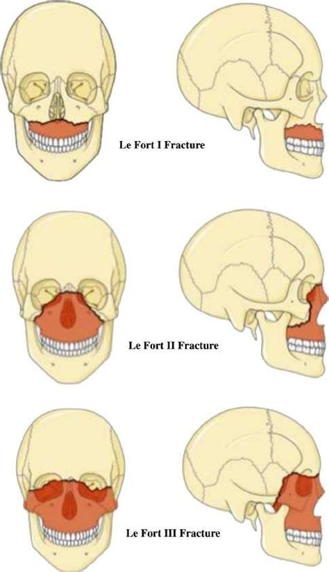 Maxillary Facial Fracture