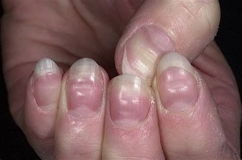 7 Health Conditions Your Nails Are Trying To Warn You Of