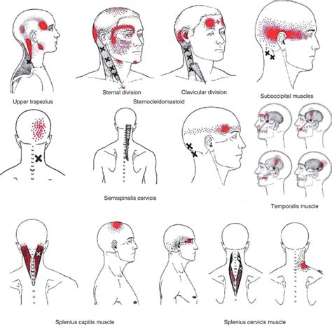 Can you determine the cause of a headache from the region of the head ...