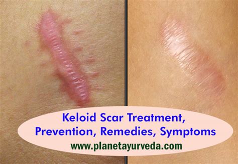 Keloid Scar Treatment, Prevention, Remedies, Symptoms - Planet Ayurveda